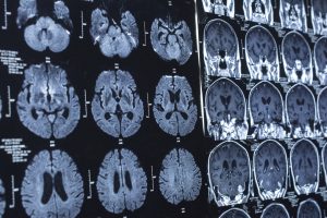 Brain scans-Parkinson's Movement