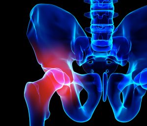 Hip painful skeleton x-ray illustration-Parkinson's Movement